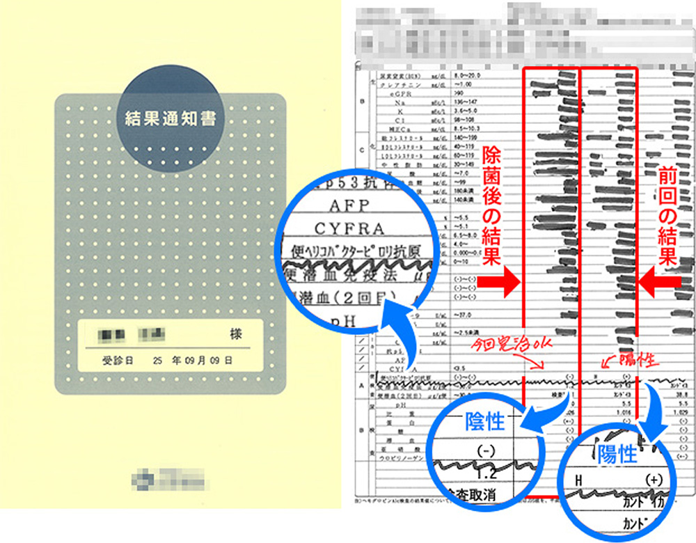 結果は「陰性」、ピロリ菌除菌薬は効果がありました！